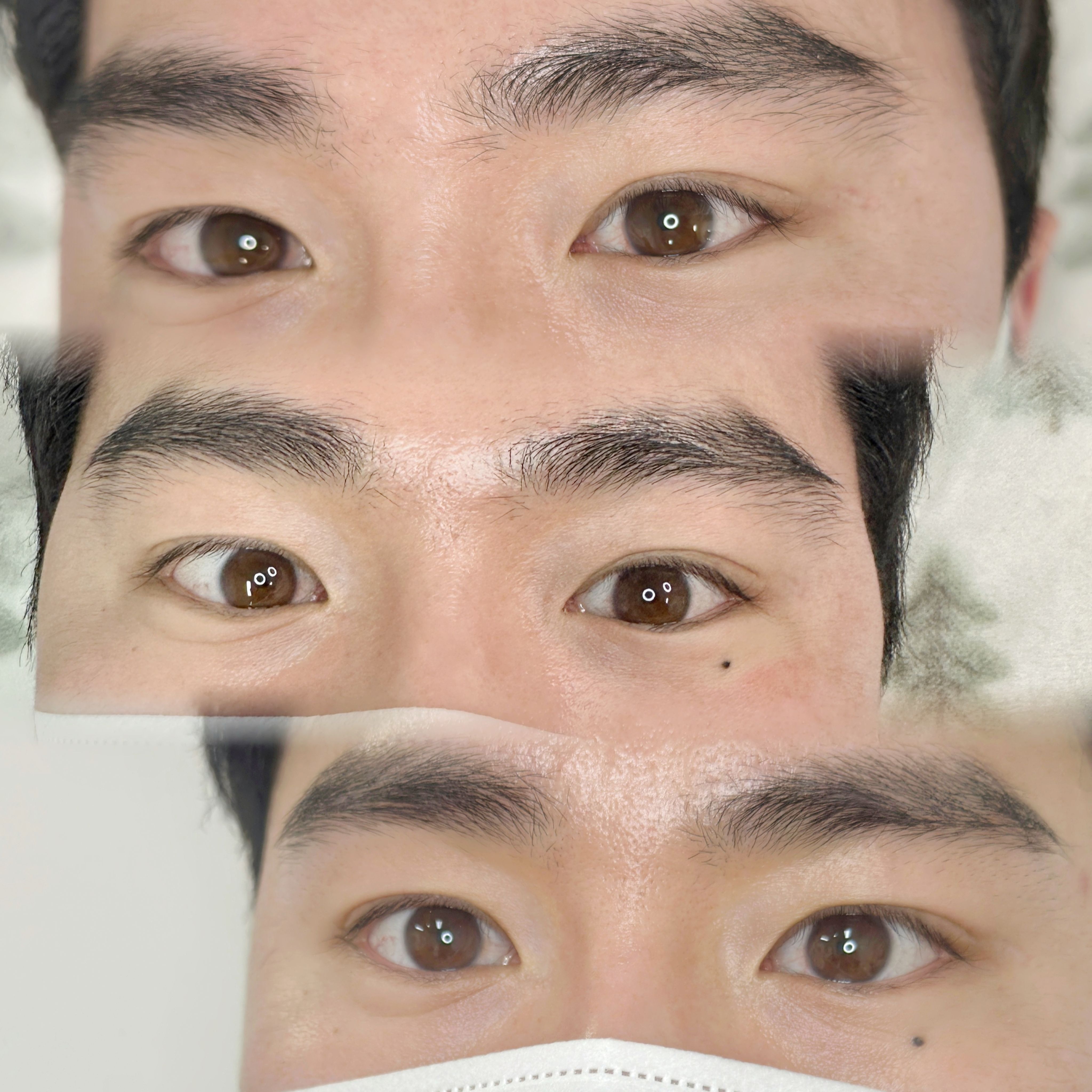 미인점 시술 전후 비교 사진